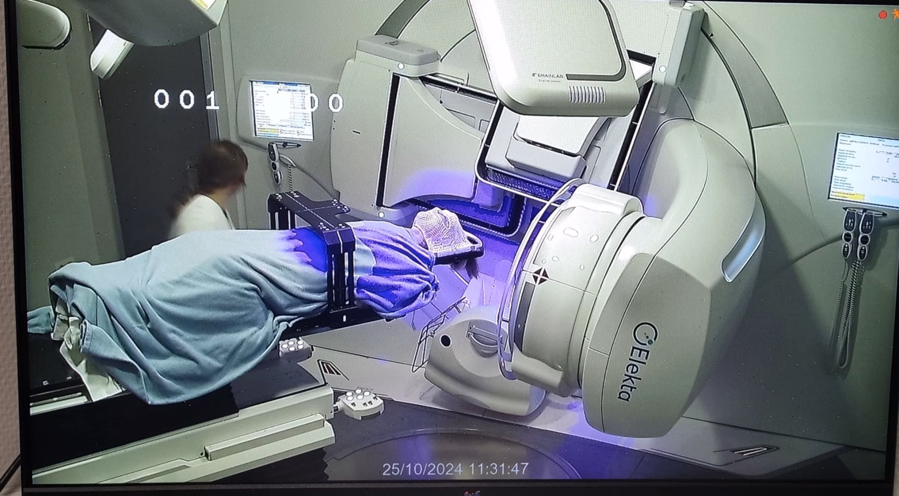 Baleares realiza la primera radiocirugía estereotáctica en un paciente con lesión cerebral